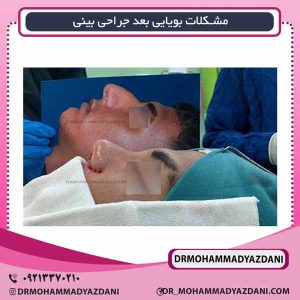 مشکلات بویایی بعد جراحی بینی دکتر محمد مسعود یزدانی